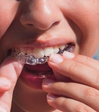 子供用マウスピース型矯正装置
